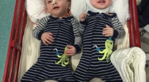 El primer encuentro de dos siameses después de haber sido separados con éxito por una operación