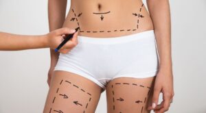 Todo lo que debes saber sobre la liposucción