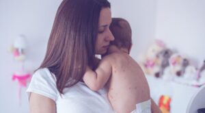 Enfermedades infantiles: ¿qué son esas manchitas rojas en la piel de los niños?