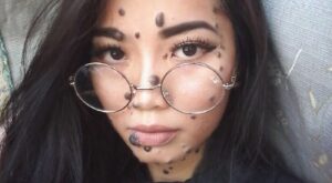 De pequeña sufrió bullying por sus verrugas, hoy puede ser la próxima Miss Universo