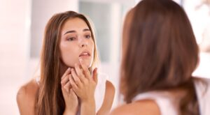 7 falsos mitos sobre el acné que deberías saber