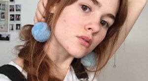 Mira el poderoso mensaje de autoestima de esta joven con acné severo