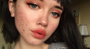 Esta instagramer muestra su acné para luchar contra los estereotipos de belleza