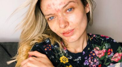 Acné Selfie, la última tendencia de belleza real en Instagram