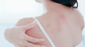 ¿Tienes picor, enrojecimiento o ronchas en la piel? Podría no ser alergia