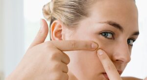 Cómo quitar puntos negros: los mejores consejos