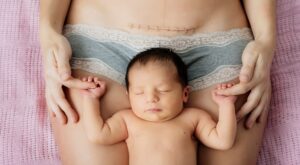 Crema para cicatrices, di adiós a las marcas de tu piel