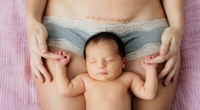 Crema para cicatrices, di adiós a las marcas de tu piel