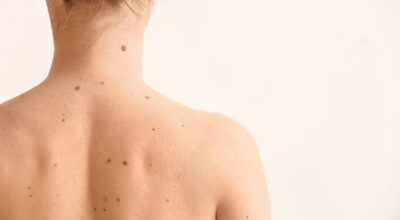 Cómo detectar lunares sospechosos y posibles melanomas con el método ABCDE