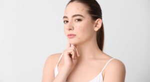 Acné digestivo: el vínculo entre alimentación y piel en mujeres