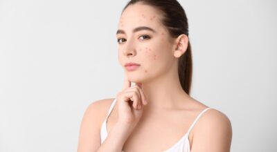 Acné digestivo: el vínculo entre alimentación y piel en mujeres