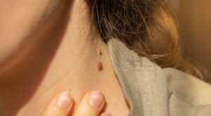 Acrocordones, los ‘fibromas blandos’ que surgen en la gestación y cómo manejarlos estéticamente