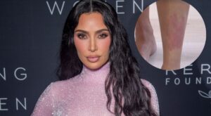 Kim Kardashian muestra su psoriasis en forma de corazón