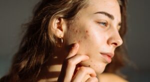 Estos son los principales mitos y verdades sobre el acné, según los especialistas