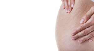 Olio di rosa mosqueta, burro di karitè, succo di limone: 10 rimedi naturali contro le smagliature