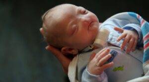 La historia de Eli, el bebé que nació sin nariz