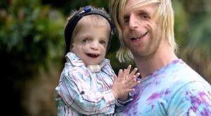 [Vídeo] Un joven sufrió bullying por su aspecto y ahora ayuda a niños con su misma enfermedad