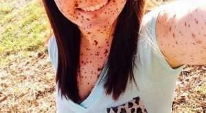 Una joven sufrió bullying por sus marcas de nacimiento hasta que decidió mostrarlas orgullosa