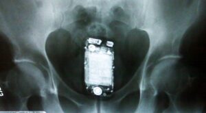 Los 24 objetos más raros encontrados, dentro de una persona, al hacer una radiografía