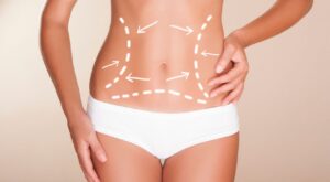 La importancia del postoperatorio tras una liposucción