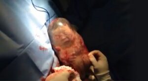 [Vídeo] Un bebé nace con la bolsa amniótica sin romper y se mueve como si estuviera en la tripa de su madre
