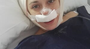 Protegido: otoplastia Ramón Calderón