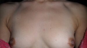 Protegido: Aumento mamario 350cc aureola