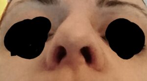 Protegido: rinoseptoplastia