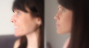 Protegido: Rino antes y despues