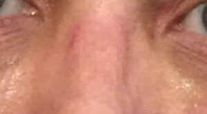 Rinoplastia Rodríguez-Camps