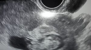 Mi bebe eco 10 semanas