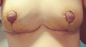 Protegido: Operacion reduccion