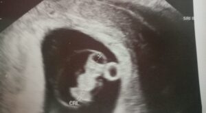 Protegido: Ecografías