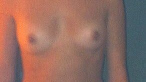 Protegido: Aumento de pecho