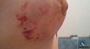 Protegido: extuberosa con mis 410cc anatómicas